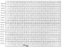 Eeg CJD.jpg