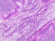 Histopathology of acute intraluminal inflammation of the appendix.jpg