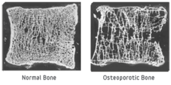 Bone Comparison of Healthy and Osteoporotic Vertibrae.png