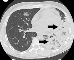 CT with consolidations with air bronchograms in legionnaires' disease.png