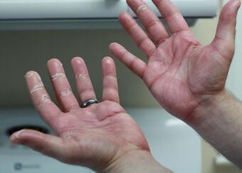Picture of hands on capecitabine exhibiting signs of chemotherapy-induced acral erythema