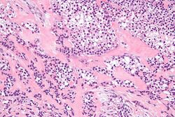 Hyalinizing clear cell carcinoma - high mag.jpg
