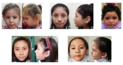 Individuals of Latin American descent with Turner syndrome (centred).png