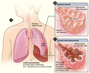 Lobar pneumonia illustrated.jpg