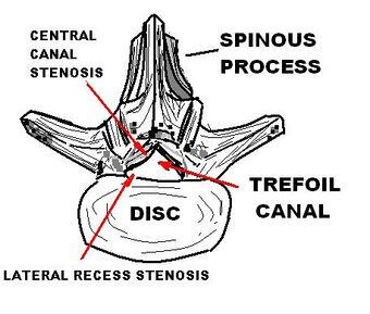 LUMBAR TREFOIL CANAL.JPG