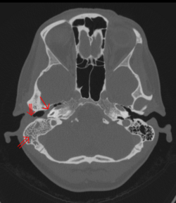 OtitisMedia Mastoiditis RightSide 153.svg