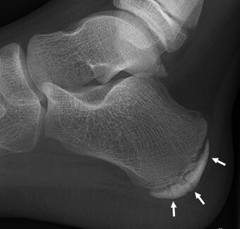 Sclerosis and fragmentation of the calcaneal apophysis.jpg