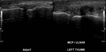 Stener lesion in ultrasound.jpg