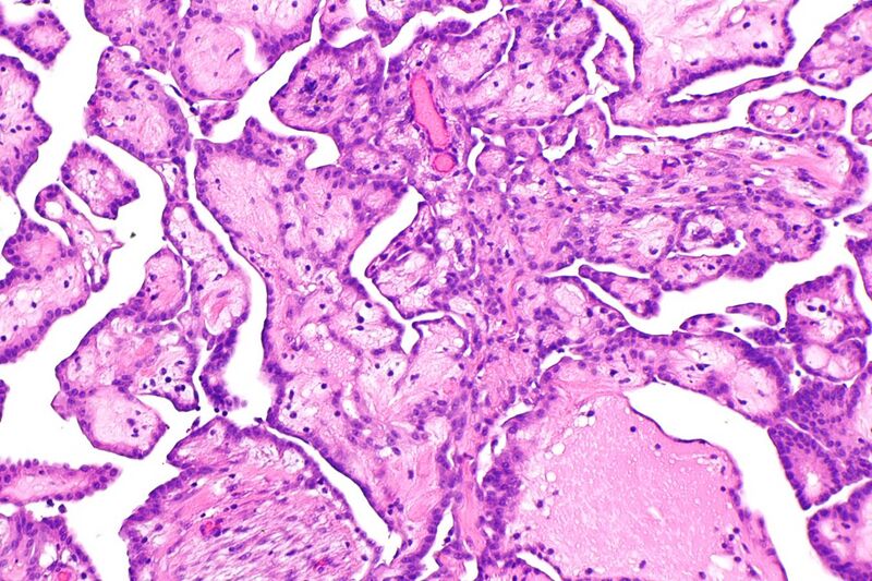 File:Well-differentiated papillary mesothelioma - alt 2 -- intermed. mag.jpg