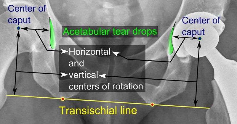 File:Center of rotation of hip prosthesis.jpg