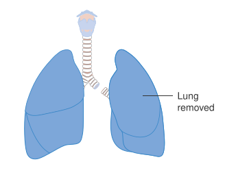 File:Diagram showing the removal of a whole lung (pneumonectomy) CRUK 365.svg