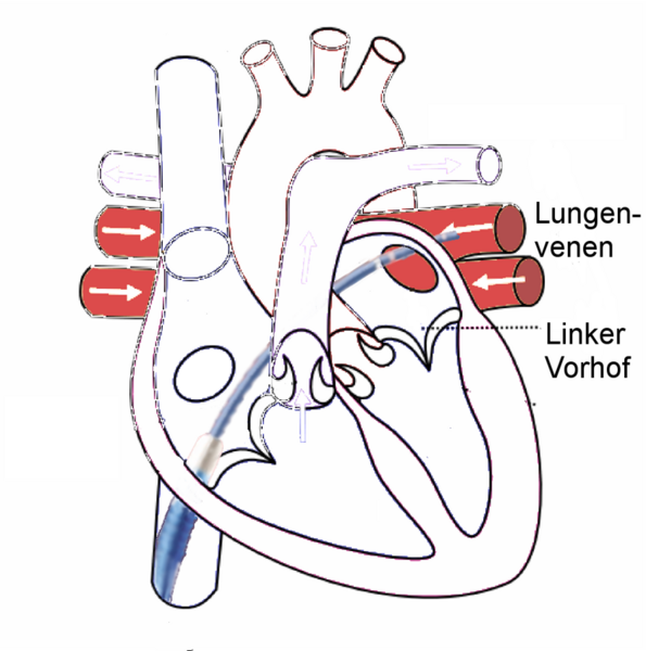 File:Herz Lungenvenenablation.png
