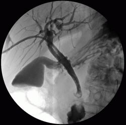 Perkutan transhepatische Cholangiographie.jpg