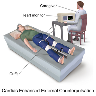 Blausen 0161 Cardiac Enhanced External Counterpulsation.png