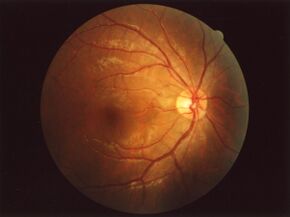 Fundus of eye normal.jpg