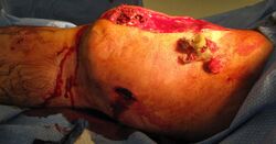 exposed shotgun wound at knee, exposed flesh