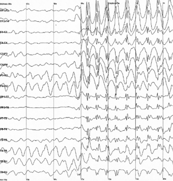 The electroencephalogram recording of a person with childhood absence epilepsy showing a seizure. The waves are black on a white background.