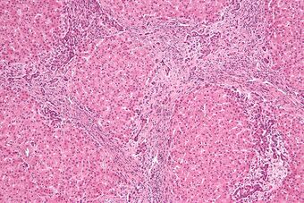 Focal nodular hyperplasia - intermed mag.jpg