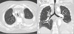 Saebelscheidentrachea bei COPD 67M - CT axial und paracoronar - 001.jpg