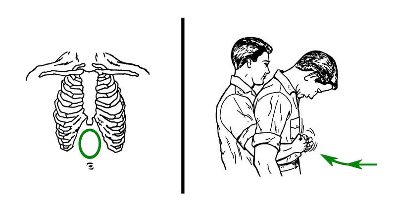 File:Abdominal thrusts against choking.jpg