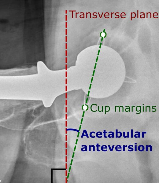 File:Acetabular anteversion of hip prosthesis.jpg