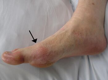 side view of a foot showing a red patch of skin over the joint at the base of the big toe