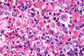 Hemophagocytic syndrome - cropped - very high mag.jpg