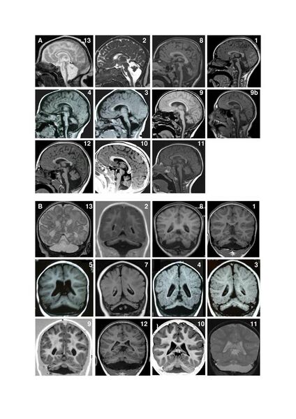 File:Pontocerebellar hypoplasia MRI 1750-1172-7-18-4-l.jpg