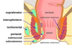 Abscess diag 02.svg