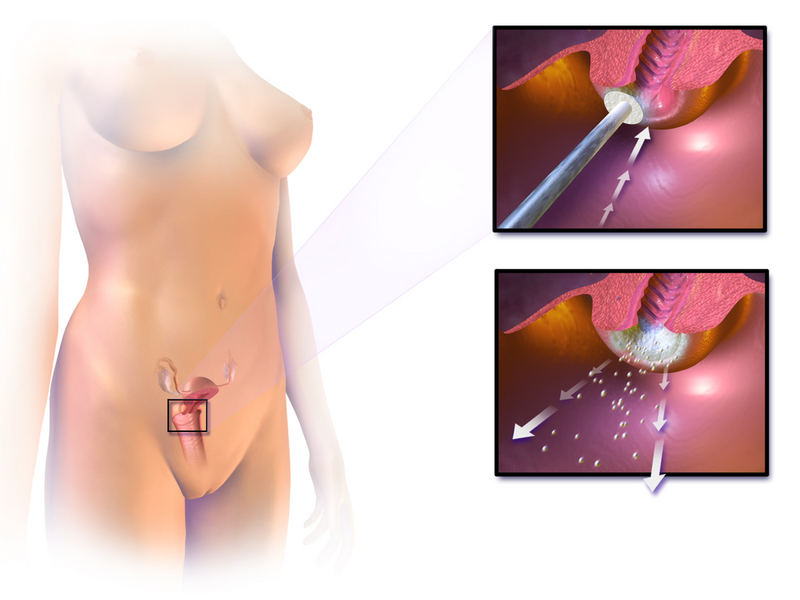 File:Cervical Cryotherapy.png