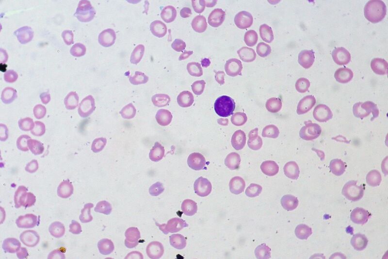 File:Iron-deficiency Anemia, Peripheral Blood Smear (4422704616).jpg