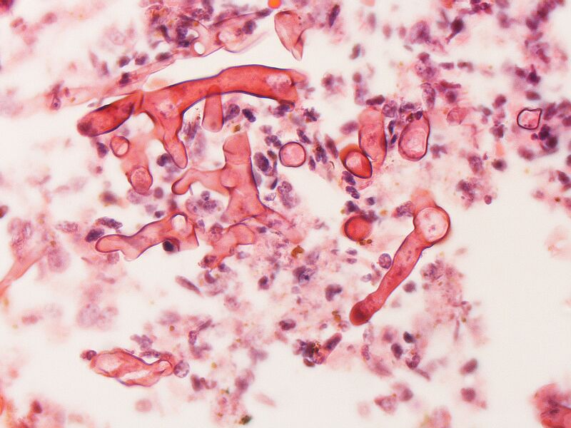 File:Zygomycosis, mucormycosis 2.jpg