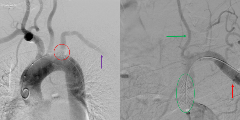 File:Angiogram of Left Subclavian Steal Syndrome.PNG