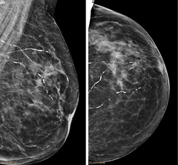 Arteriolosclerosis mammography.png