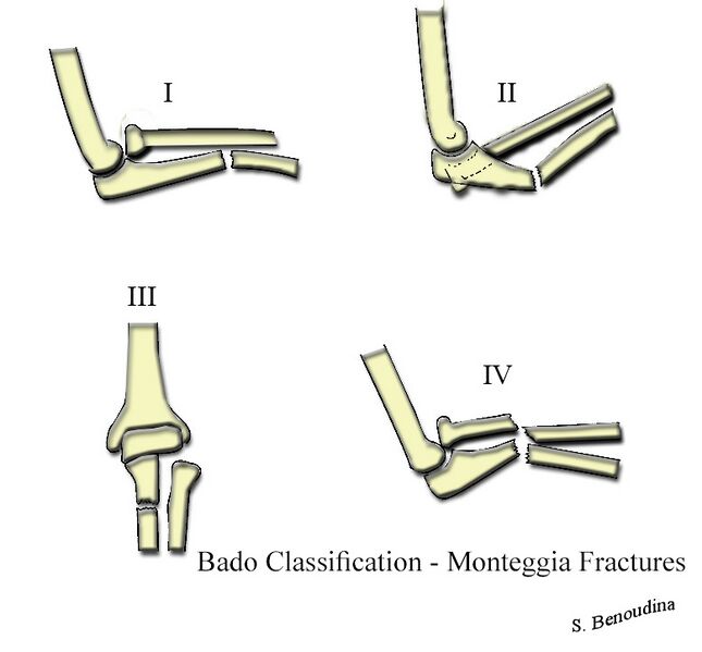 File:Bado Classification - Monteggia Fractures.jpg