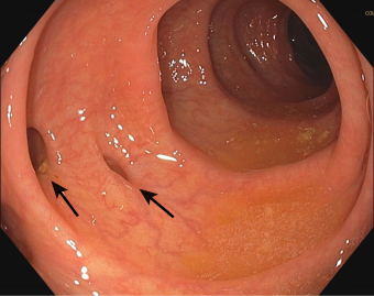 Diverticulosis (two diverticula) 01.svg