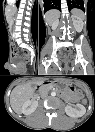 CT of a normal abdomen and pelvis, thumbnail.png