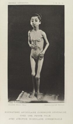 Photograph of young girl with muscular atrophy Wellcome L0034939.jpg