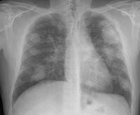Xray of lungs, lighter patches visible