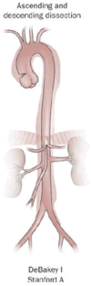 Aortic dissection of DeBakey type I.png