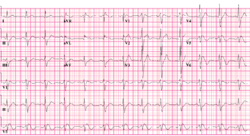 Brugada syndrome type1 example1 (CardioNetworks ECGpedia).png