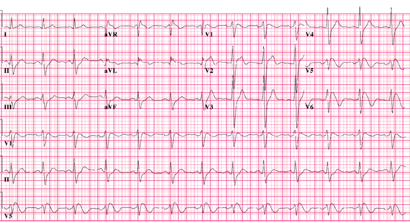 File:Brugada syndrome type1 example1 (CardioNetworks ECGpedia).png