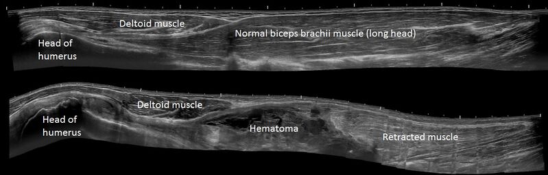 File:Panoramic ultrasonography of biceps tendon rupture - Annotated.jpg