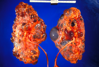 Polycystic kidneys, gross pathology CDC PHIL.png
