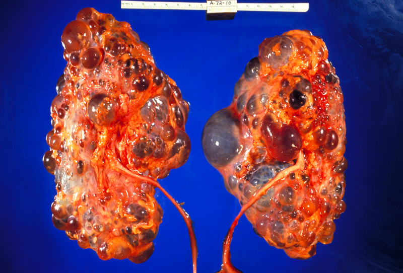 File:Polycystic kidneys, gross pathology CDC PHIL.png