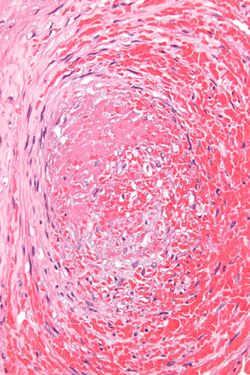 Fetal thrombotic vasculopathy - very high mag.jpg