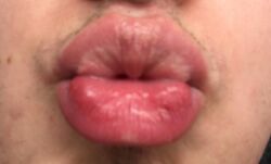 Close-up of lips with fordyce spots