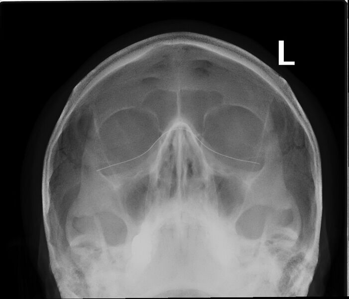 File:Paranasal sinuses radiograph occipitomental.jpg