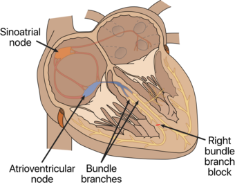 Right bundle branch block (RBBB) of the human heart.svg