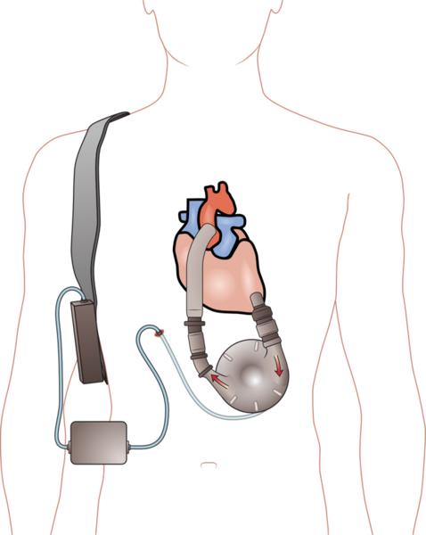 File:Ventricular assist device.png